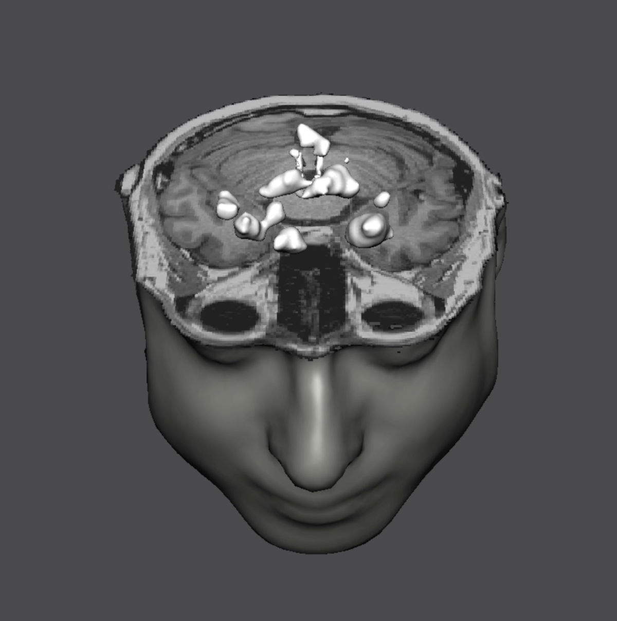 Itamar Gilboa's MRI.
